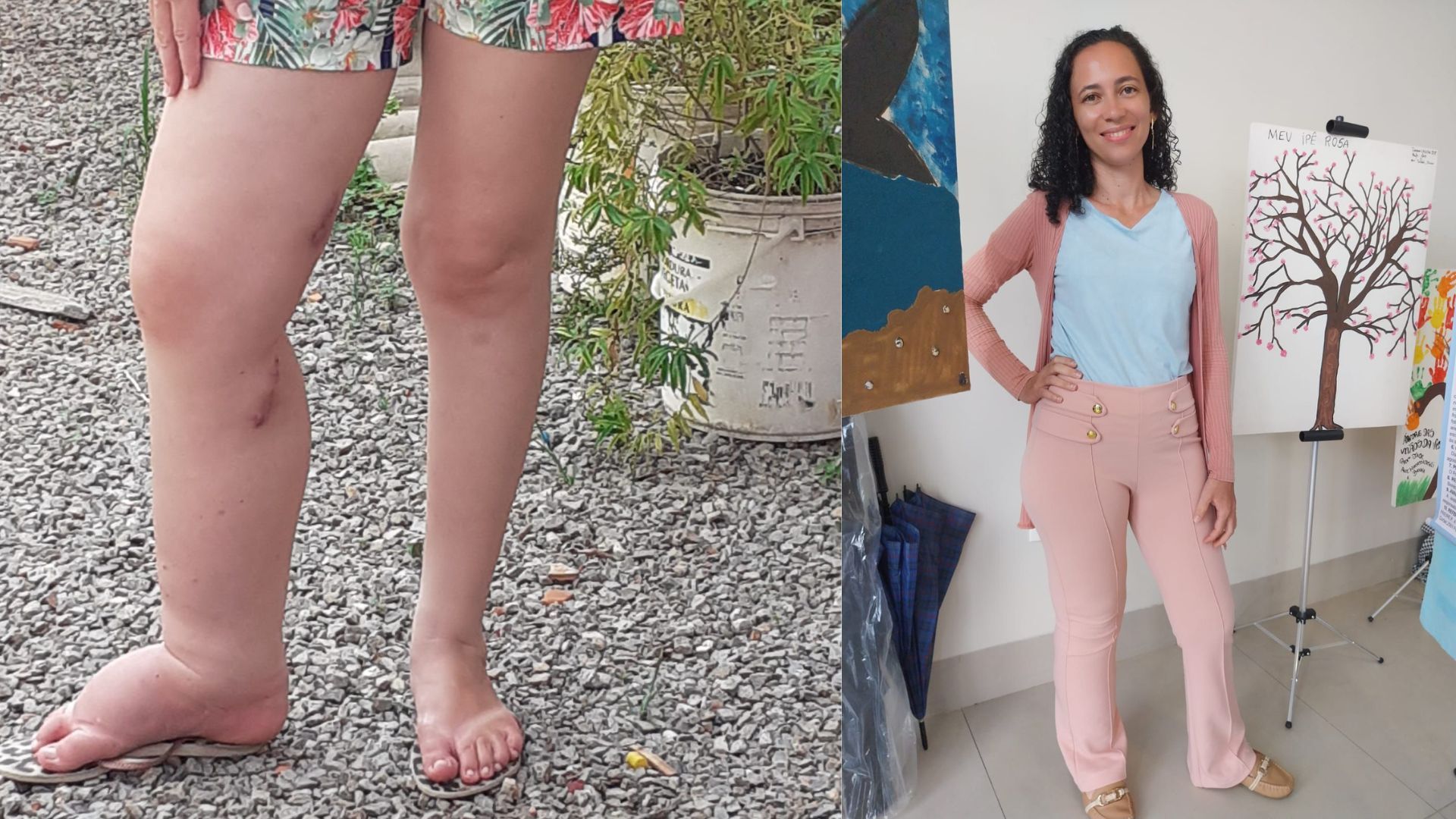  Elizabeth Rezende passou por microcirurgia rara na Bahia