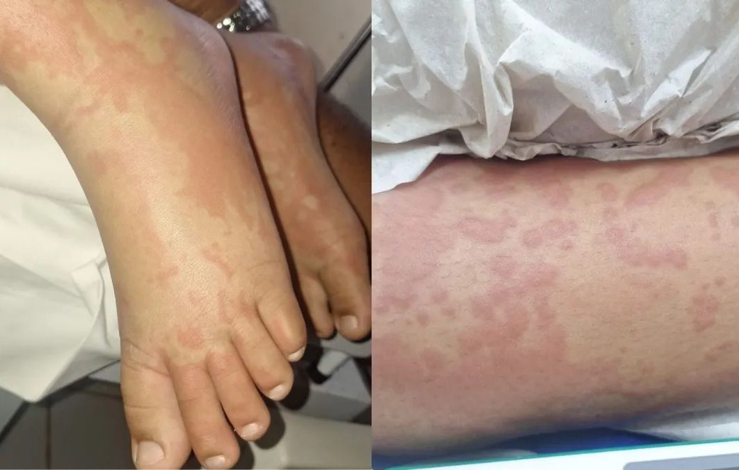 Uma crian&ccedil;a foi internada com suspeita de contamina&ccedil;&atilde;o ap&oacute;s uso de detergente da marca Yp&ecirc;. | Foto: Redes Sociais