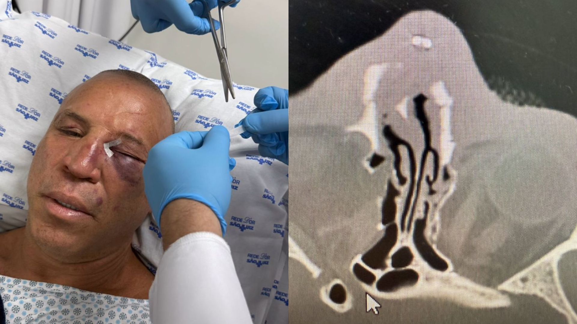 Da equipe de Wanderlei, Wedum falou que lutador quebrou o nariz e foi levado a hospital | Imagens: redes sociais