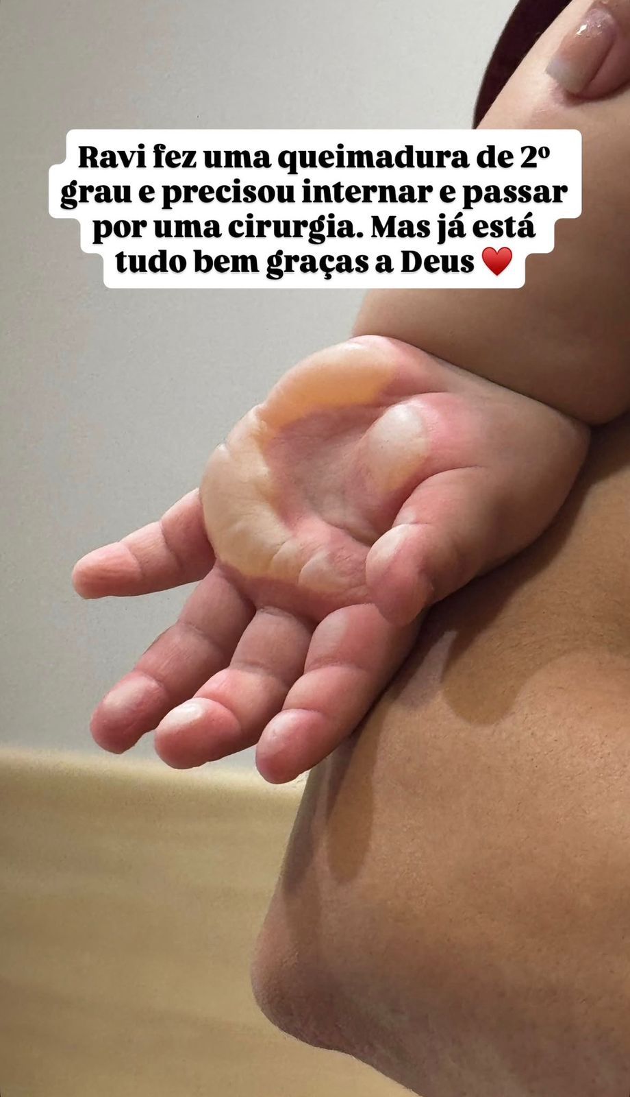 O filho de Viih Tube e Eliezer, Ravi, de um ano, precisou ser internado e passou por uma cirurgia ap&oacute;s sofrer uma queimadura. | Foto: Redes Sociais