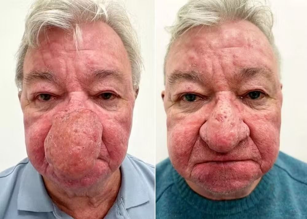 McAliece notou as primeiras alterações há cerca de seis anos, quando o nariz começou a aumentar gradualmente. | Foto: Redes Sociais
