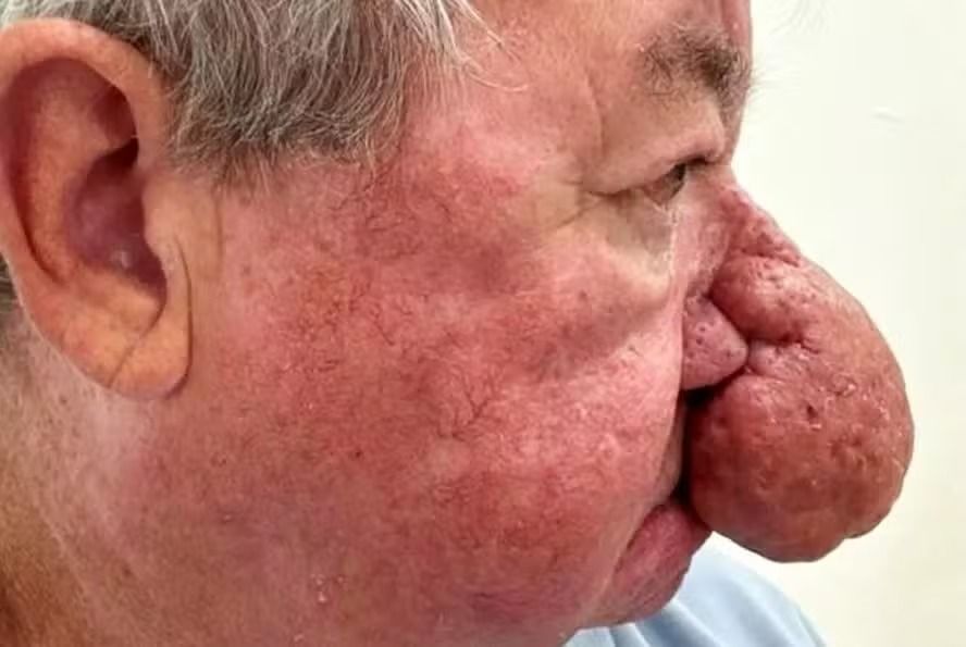 O escocês Gerard McAliece, de 68 anos, passou por uma cirurgia complexa após desenvolver um dos casos mais graves de rinofima já registrados no Reino Unido. | Foto: Redes Sociais